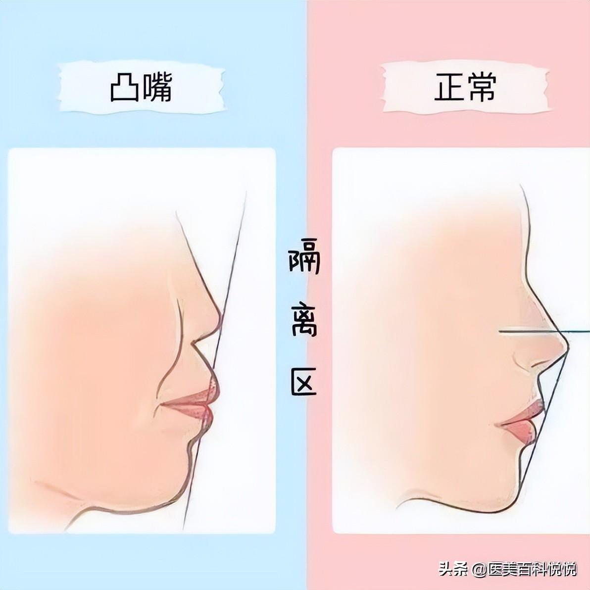 江苏苏王——怎么让侧脸变好看 ？你的侧脸合格了吗？